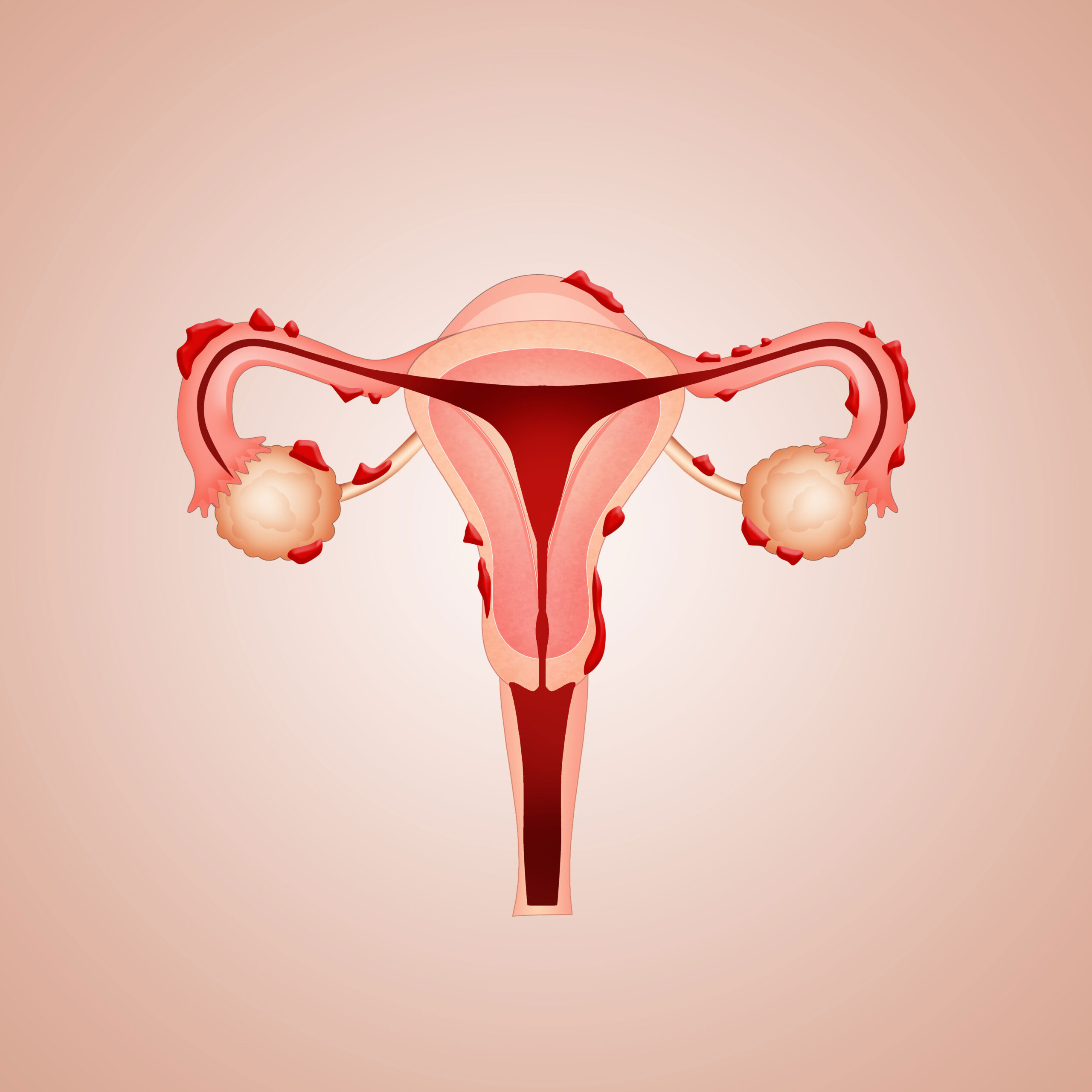 Wucherungen im Bauchraum an Eierstöcken und Gebärmutter